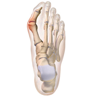 Tynor Bunion Splint (UN) (K 14)