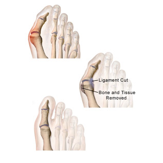 Tynor Bunion Splint (UN) (K 14)